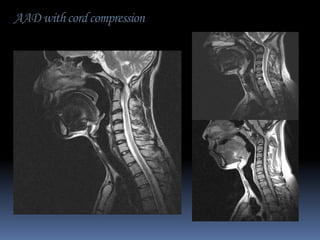 AAD with cord compression

 