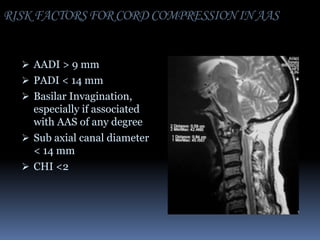 RISK FACTORS FOR CORD COMPRESSION IN AAS
 AADI > 9 mm
 PADI < 14 mm
 Basilar Invagination,

especially if associated
with AAS of any degree
 Sub axial canal diameter
< 14 mm
 CHI <2

 