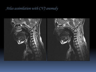 Atlas assimilation with CVJ anomaly

 