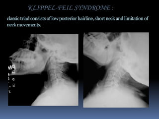 KLIPPEL-FEIL SYNDROME :
classic triad consists of low posterior hairline, short neck and limitation of
neck movements.

 