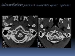 Atlas rachischisis: posterior >> anterior Both together – ‘split atlas’

 