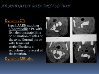 ATLANTO-AXIAL ROTATORY FIXATION
Dynamic CT:
type I AARF vs. other
c/o torticollis : Pt. with
fixn demonstrate little
or no motion of atlas on
the axis. Normal pts or
with transient
torticollis show a
reduction or reversal of
the rotation.

Dynamic MRI also

 