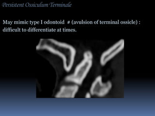 Persistent Ossiculum Terminale
May mimic type I odontoid # (avulsion of terminal ossicle) :
difficult to differentiate at times.

 