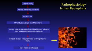 Pathophysiology
Intimal Hyperplasia
 