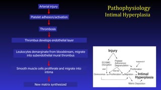 Pathophysiology
Intimal Hyperplasia
 