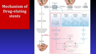 Mechanism of
Drug-eluting
stents
 