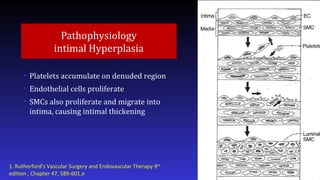 Pathophysiology
intimal Hyperplasia
• Platelets accumulate on denuded region
• Endothelial cells proliferate
• SMCs also proliferate and migrate into
intima, causing intimal thickening
1. Rutherford's Vascular Surgery and Endovascular Therapy 9th
edition , Chapter 47, 589-601.e
 