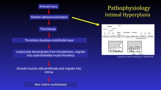 Pathophysiology
Intimal Hyperplasia
Conde et.al. Cath & Cardiovasc Int. 2003;60:236
 