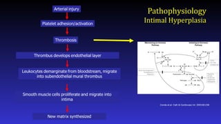 Pathophysiology
Intimal Hyperplasia
Conde et.al. Cath & Cardiovasc Int. 2003;60:236
 