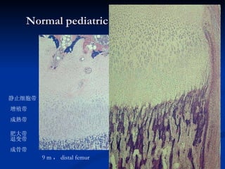 Normal pediatric X-ray appearances 9 m ， distal femur 增殖带 成熟带 肥大带 退变带 成骨带 静止细胞带 { 