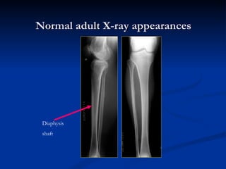 Normal adult X-ray appearances Diaphysis shaft 