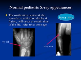 Normal pediatric X-ray appearances The ossification centers & the secondary ossification display & fusion,  will occur at certain time of the life,  refer to as bone age Bone age yrs ±1 New born 