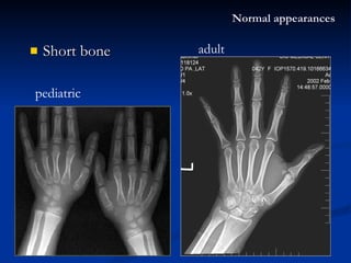 Short bone Normal appearances pediatric adult 