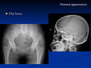 Flat bone Normal appearances 