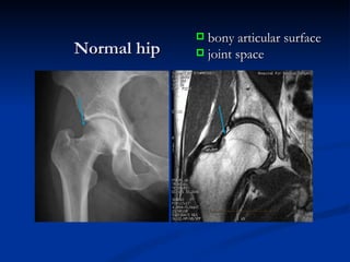 Normal hip bony articular surface joint space 