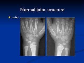 wrist Normal joint structure 