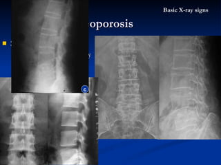 Spine oteoporosis Vertibral body deformity as  “ fish vertibral ” Bone density decreased Trabecula thinner Osteoporosis Basic X-ray signs normal c 