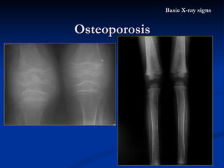 Thallassaemia  Chronic haemolytic anaemias cause widening of the spongiosa / cortex thinning in the proximal ends of long bone Osteoporosis Basic X-ray signs 