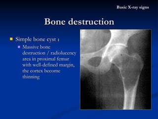 Simple bone cyst ： Massive bone destruction / radiolucency area in proximal femur with well-defined margin, the cortex become thinning Bone destruction Basic X-ray signs 