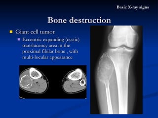 Giant cell tumor Eccentric expanding (cystic)  translucency area in the proximal fibilar bone , with multi-locular appearance Bone destruction Basic X-ray signs 