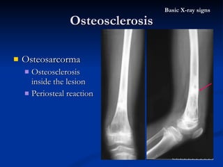 Osteosarcorma  Osteosclerosis inside the lesion Periosteal reaction Osteosclerosis Basic X-ray signs 