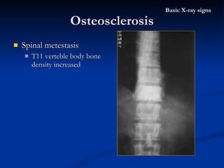 Spinal metestasis T11 verteble body bone density increased Osteosclerosis Basic X-ray signs 