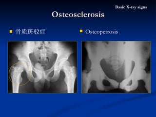 骨质斑驳症 Osteosclerosis Basic X-ray signs Osteopetrosis  