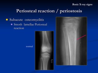 Subacute  osteomyelitis Smoth  lamellae Periosteal reaction  Periosteal reaction / periostosis Basic X-ray signs normal 