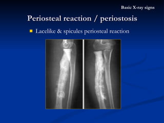 Lacelike & spicules periosteal reaction Periosteal reaction / periostosis Basic X-ray signs 