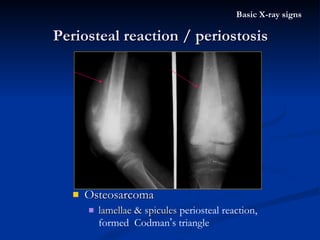 Osteosarcoma  lamellae & spicules  periosteal reaction,  formed  Codman ’ s triangle Periosteal reaction / periostosis Basic X-ray signs 