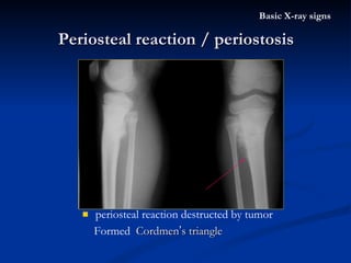 periosteal reaction destructed by tumor Formed  Cordmen ’ s triangle Periosteal reaction / periostosis Basic X-ray signs 