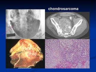 chondrosarcoma 