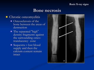 Chronic osteomyelitis  Osteosclerosis of the bone between the areas of destruction The separated  “ high ”  density fragments against the surrounding osteo-translucency  zone Sequestra  –  lost blood supply and then the calcium content remain intact Bone necrosis Basic X-ray signs 