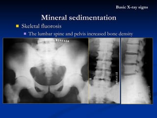 Skeletal fluorosis The lumbar spine and pelvis increased bone density Mineral sedimentation Basic X-ray signs 