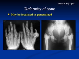 Deformity of bone Basic X-ray signs May be localized or generalized 