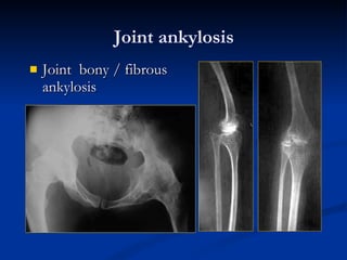 Joint ankylosis Joint  bony / fibrous ankylosis 