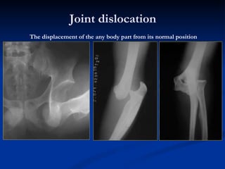 Joint dislocation The displacement of the any body part from its normal position 