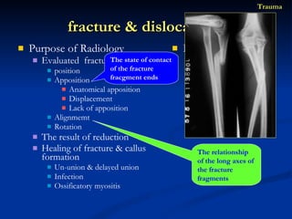 Purpose of Radiology Evaluated  fracture / dislocation position Apposition  Anatomical apposition Displacement Lack of apposition Alignmemt  Rotation  The result of reduction Healing of fracture & callus formation Un-union & delayed union Infection  Ossificatory myositis Imagine technique X-ray CT MRI US SCINTIGRAPHY fracture & dislocation  Trauma The state of contact of the fracture fracgment ends The relationship of the long axes of the fracture fragments 