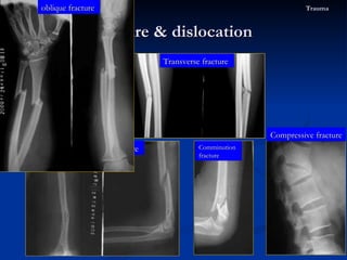 The fracture types Fracture & dislocation  Trauma spiral fracture Transverse fracture Compressive fracture Comminution fracture oblique fracture   