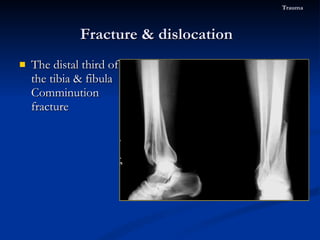 The distal third of the tibia & fibula Comminution fracture  Fracture & dislocation  Trauma 