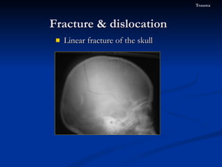 Linear fracture of the skull Fracture & dislocation  Trauma 