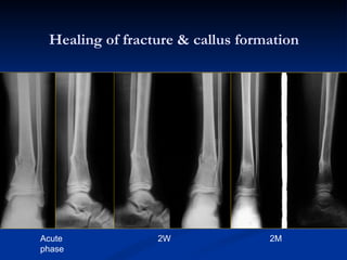 Healing of fracture & callus formation Acute phase 2W 2M 