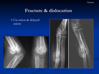 Un-union & delayed union Fracture & dislocation  Trauma 