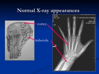 Normal X-ray appearances cortex trabecula 