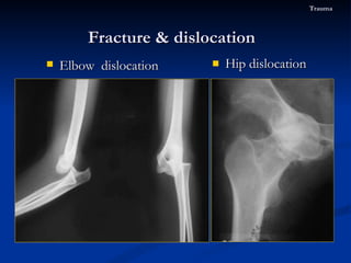 Hip dislocation Fracture & dislocation  Trauma Elbow  dislocation 