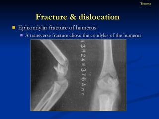 Epicondylar fracture of humerus A transverse fracture above the condyles of the humerus Fracture & dislocation  Trauma 