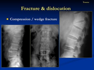 Compression / wedge fracture Fracture & dislocation  Trauma 