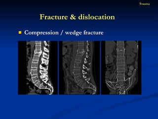 Compression / wedge fracture Fracture & dislocation  Trauma 