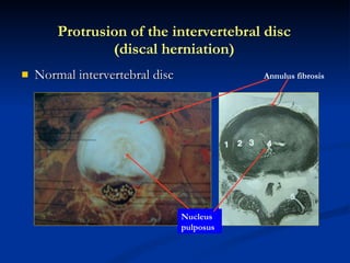 Normal intervertebral disc Protrusion of the intervertebral disc (discal herniation) Annulus fibrosis Nucleus pulposus 