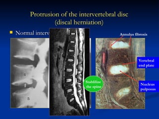 Protrusion of the intervertebral disc (discal herniation) Normal intervertebral disc Annulus fibrosis Nucleus pulposus Vertebral end plate Stablilize the spine 